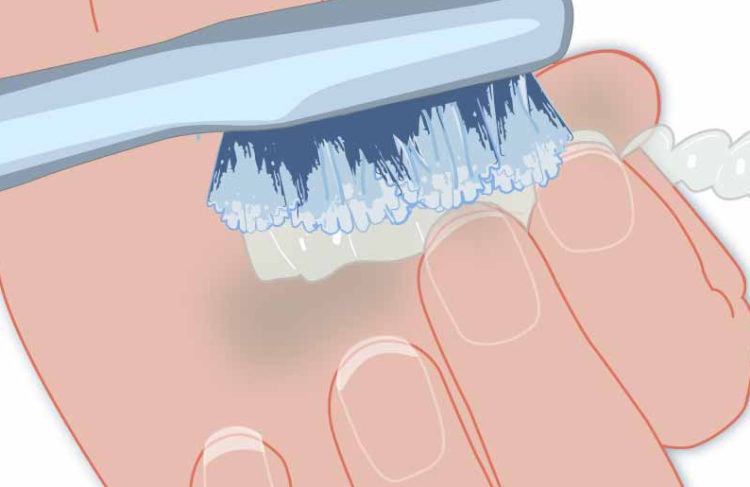 illustration d'un brossage pour un blanchiment des dents, dentisterie esthétique