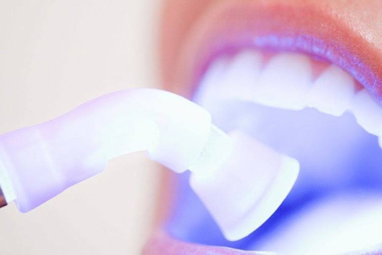 photo d'une lampe à polymériser illustrant la dentisterie esthetique, clinique dentaire newport pantin